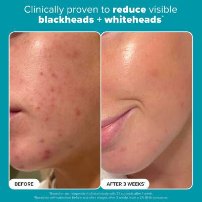 Paula's Choice Skin Perfecting 2% BHA Exfoliating Toner Pads