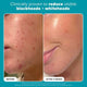 Paula's Choice Skin Perfecting 2% BHA Exfoliating Toner Pads