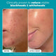 Paula's Choice Skin Perfecting 2% BHA Liquid Exfoliant - Travel Size 30ml