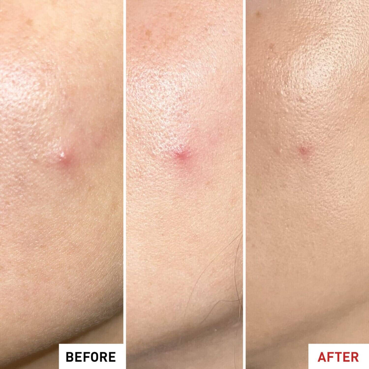 erborian Centella SOS Patch-Effect Gel 9ml