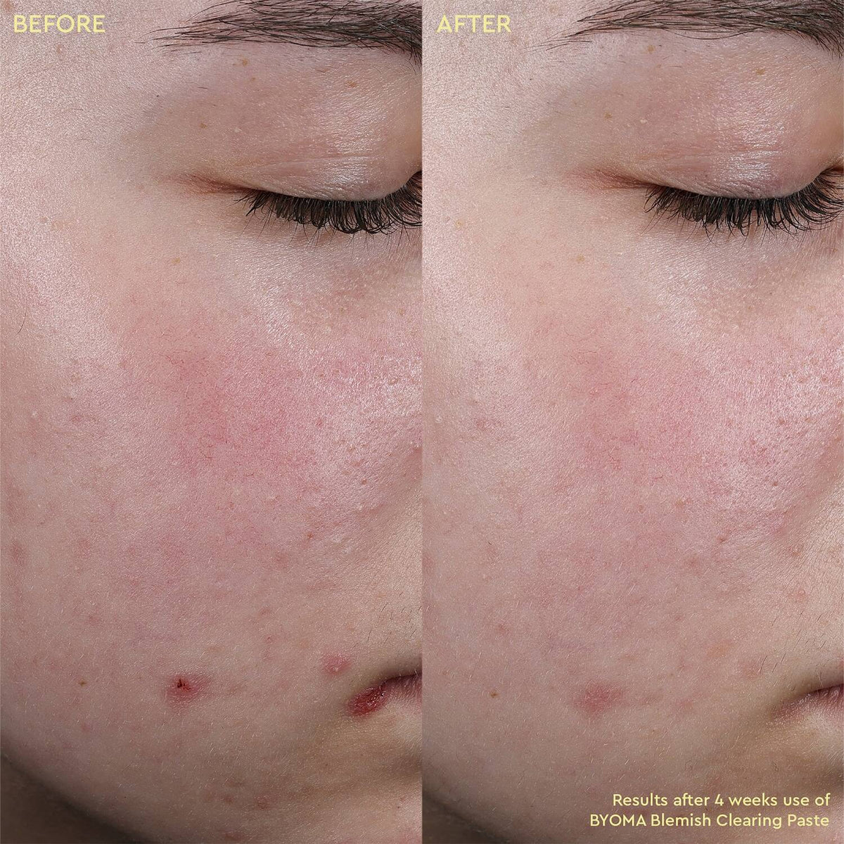 BYOMA Blemish Clearing Paste 15ml